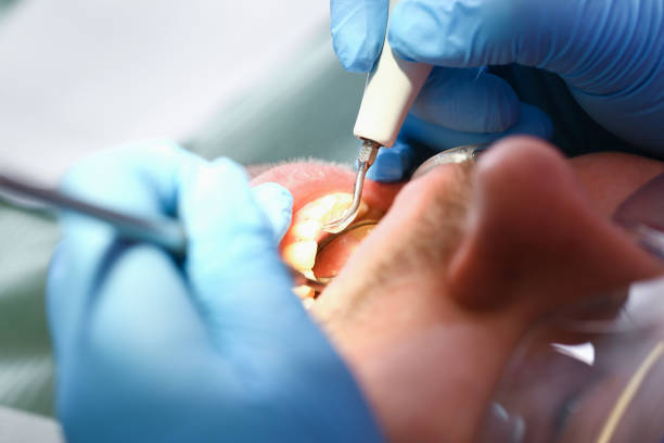 Best Emergency Wisdom Teeth Removal in Orangevale, CA